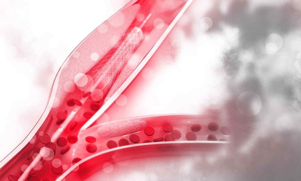 Αρτηριακή υπέρταση - Παθολόγος - Διαβητολόγος Αγγελος Κλείτσας